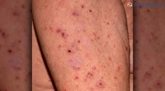 Byty na Orechovom dvore v Nitre musia vyplynovať. Rozmnožili sa tu ploštice a svrab