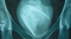 Lekárov prekvapil nález v tele ženy. Gigantický obličkový kameň obsahoval nečakaný predmet