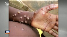 Svetová zdravotnícka organizácia vyhlásila pre opičie kiahne medzinárodný stav ohrozenia