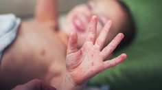 WHO varuje pred epidémiou osýpok v Európe. Zabili už desiatky ľudí