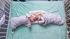 Vo Philadelphii oddelili desaťmesačné siamské dvojčatá. Spojené boli hlavami