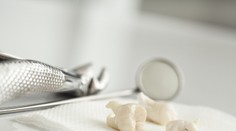 Odstránenie zubu múdrosti má podľa vedcov pozitívny vplyv. Bližšie ho opísali v tejto štúdii