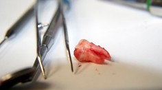 Sťažoval sa na "plný nos" a zlé dýchanie. Vyšetrenie odhalilo v dutine zaklieštený zub