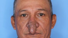 Muž prišiel brigádovať k plastickému chirurgovi. Keď ten uvidel jeho nos, dal mu nezvyčajný dar