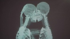 Láska cez röntgen. Aj vás zaskočí, komu patria kostry?