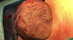 Fascinujúce zábery cisárskeho rezu. Dieťa sa samé predralo na svet