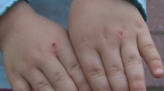 Rodičov na juhu Slovenska vystrašila podivná choroba detí