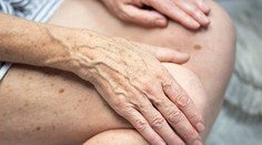 Trápia vás starecké škvrny? Zbavíte sa ich aj týmito potravinami