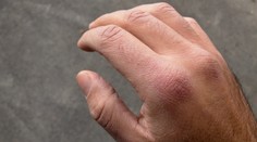 Ako zistíte, že ste dehydratovaný? Odhaliť vám to pomôžu dva jednoduché testy