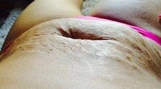 Päťnásobnej matke sa na pláži smiali, tak ukázala strie na Facebooku