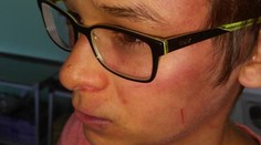 Ďalší dobitý chlapec. Matka tvrdí, že na jej syna zaútočil riaditeľ školy