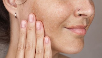 Slnečné lúče, citrusy a figy: Odkiaľ sa berú pigmentové fľaky na pokožke a ako sa ich zbaviť?