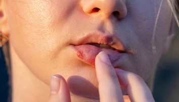 Herpes ostáva v tele navždy. Prečo by ste mali obmedziť čokoládu a oriešky?