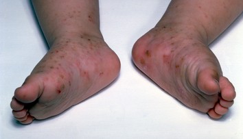 Na Slovensku pribúdajú prípady svrabu, najviac ohrozené sú deti a tínedžeri