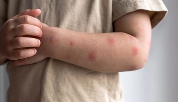 Nie je to komár. Muchnička môže spôsobiť bolestivé opuchy aj silné svrbenie