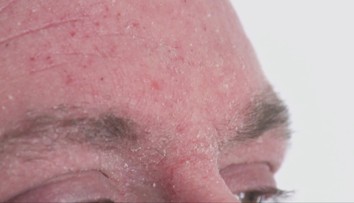 Páli a štípe vás koža? Slováci hlásia veľké problémy. Odborníčky radia, čo robiť