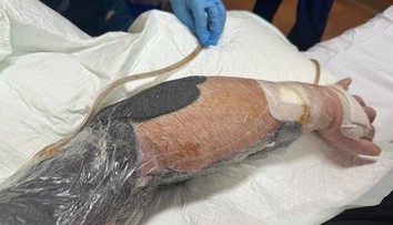 Mäsožravá infekcia mu takmer vzala život. V jednu chvíľu mi bolo vidieť skrz ruku, popísal