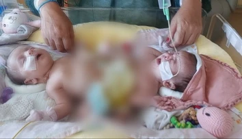 Siamské dvojčatá spod Tatier čaká zlomová operácia. Oddelia ich na prestížnej klinike v Saudskej Arábii