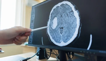 Revolúcia v liečbe rakoviny: Nový test skrátil diagnostiku nádorov mozgu z týždňov na hodiny
