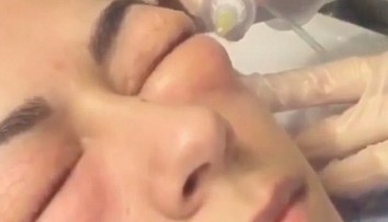 Z tohto estetického zákroku ide strach. Zježia sa vám chlpy