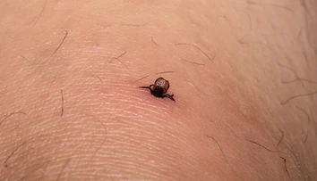 Zostal vám po vybratí kúsok kliešťa v koži? Lekárka radí, čo s ním určite nerobiť