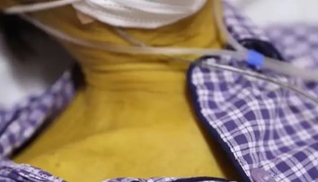 Farba mužovej pokožky sa odrazu zmenila na žltú. Lekárom sa napokon podarilo zistiť príčinu