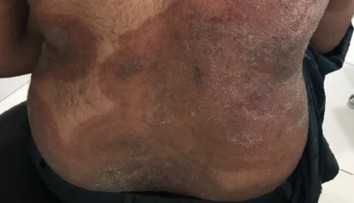 Európou sa valí superpleseň: Vedci varujú, že o chvíľu pred ňou nebude úniku. Postihuje celé telo, liečba je náročná