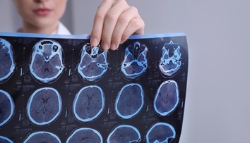 Vedci odhalili bunky, ktoré ničia mozog. Objav môže zmeniť liečbu sklerózy