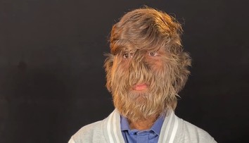 Mladík má vzácny vlkolačí syndróm. Získal vďaka tomu svetový rekord