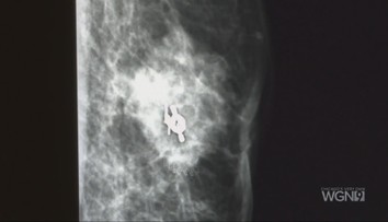 Nádor na prsníkoch neohrozuje len ženy. U mužov je ochorenie výrazne agresívnejšie