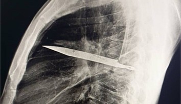 Prípad, ktorý šokoval lekárov. Muž žil osem rokov s nožom v hrudi