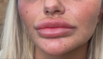 Uvažujete nad plastickou operáciou? Kyselina hyalurónová môže spôsobovať komplikácie