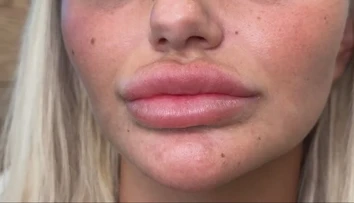 Uvažujete nad plastickou operáciou? Kyselina hyalurónová môže spôsobovať komplikácie