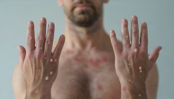 Opičie kiahne sa šíria aj u nás. Hygienici nevylučujú ďalšie prípady