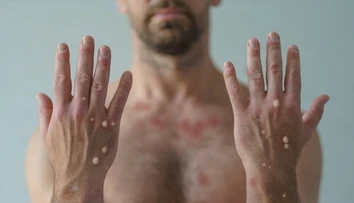 Opičie kiahne sa šíria aj u nás. Hygienici nevylučujú ďalšie prípady