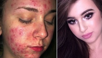 Tínedžerka trpela hrozným akné. Takto ho dokázala maskovať