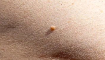 Malé kožné výrastky vyzerajú nevinne. Dermatologička varuje pred ich domácim odstraňovaním