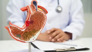 Rakovina žalúdka sa spočiatku prejavuje nenápadne. Najčastejšie príznaky, ktoré ľudia ignorujú