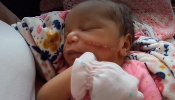 Nadšenie a radosť vystriedalo zdesenie. Dievčatko sa narodilo s obrovskou ranou na tvári