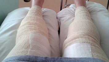 Šokujúci prípad. Oholila sa v oblasti bikín a takmer prišla o nohy