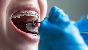 Populárny liek má nečakaný vedľajší účinok. Odborníci varujú pred problémami so zubami