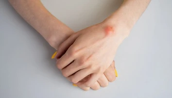 Nahmatali ste si hrčku pod kožou? Jeden detail prezradí viac než si myslíte