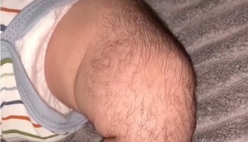 VIDEO: Bábätko trpiace ojedinelým stavom trápi ďalší problém. Lieky spôsobili masívne ochlpenie