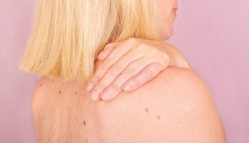 Rakovina, ktorú môžeme vidieť voľným okom. Ktoré kožné zmeny by ste nikdy nemali ignorovať?