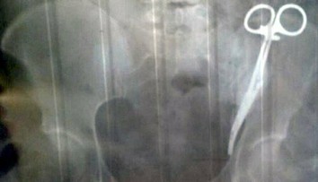 Viac ako 20 rokov má v tele chirurgické nožnice, zašili jej ich počas cisárskeho rezu