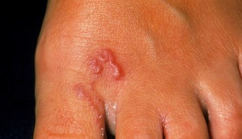 Pozor na nechcený suvenír z dovolenky. Strašidelného tropického parazita môžete chytiť na pláži