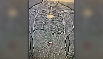 Muž mal ukradnúť luxusné náušnice za trištvrte milióna dolárov. Našli sa na röntgenovej snímke v jeho orgáne