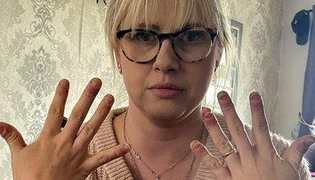 Žena roky nosila gélové nechty, teraz to horko ľutuje. Znetvorené prsty už takmer nedokáže ohnúť