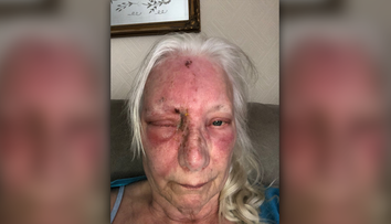 Otrava slnkom? Žena skončila s opuchmi a pľuzgiermi po krátkom zdriemnutí na záhrade