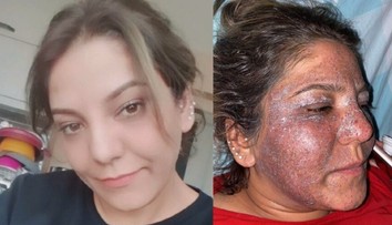 Túžila po vyhladení vrások, po zvláštnom zákroku však skončila s hnisom a opuchmi na tvári